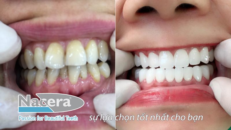 Răng sứ Nacera