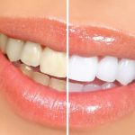 Tẩy trắng răng là gì?