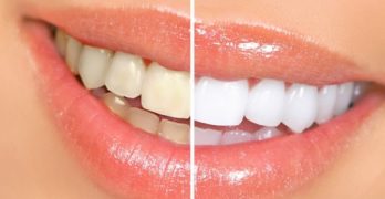 Tẩy trắng răng là gì?