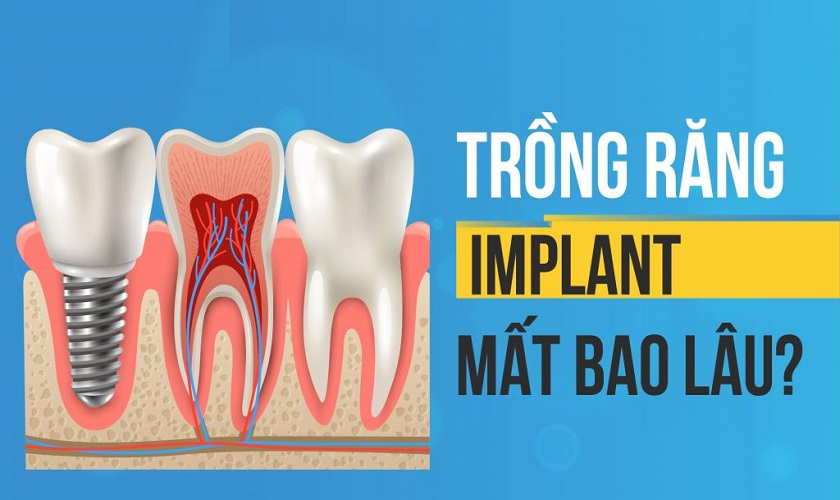 Trồng Răng Implant Mất Bao Lâu NHA KHOA PHUONG ANH