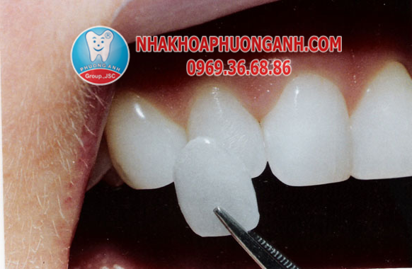 Mặt dán sứ Veneer siêu mỏng veneer-1