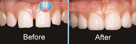 Nha Khoa Phương Anh veneer-2