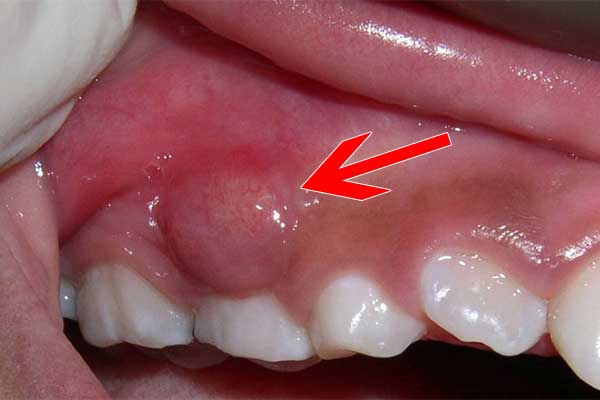 Nhiễm trùng vùng nướu có thể dẫn đến những vấn đề nghiêm trọng về răng miệng. Hãy xem hình ảnh để biết cách phát hiện và xử lý tình trạng này.
