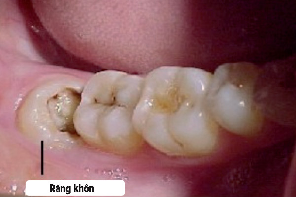 Cùng tìm hiều về những chiếc răng số 8 để hiểu tại sao răng trong cùng của mình hay bị sưng viêm. Răng số 8 có cần thiết phải nhổ bỏ hay không?
