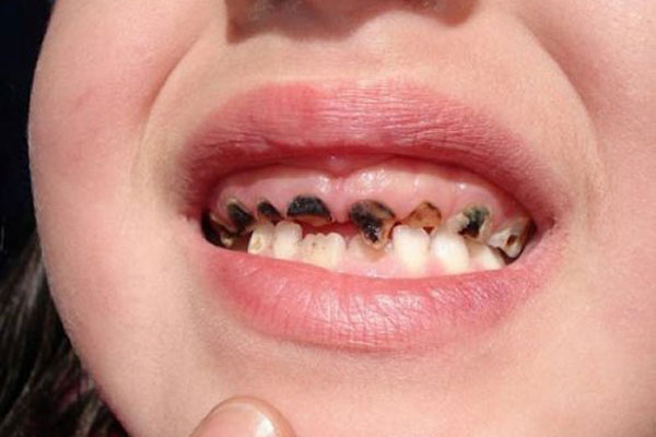 Bệnh sún răng ở trẻ - NHA KHOA PHUONG ANH