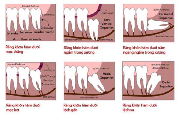 phân loại răng khôn